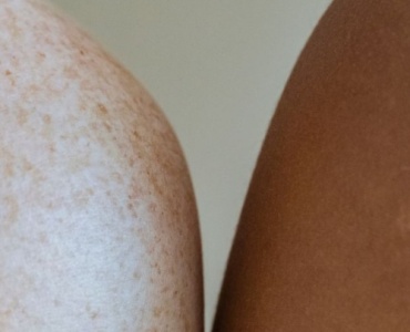 Adieu les taches sur le corps : 7 solutions efficaces pour retrouver une peau uniforme